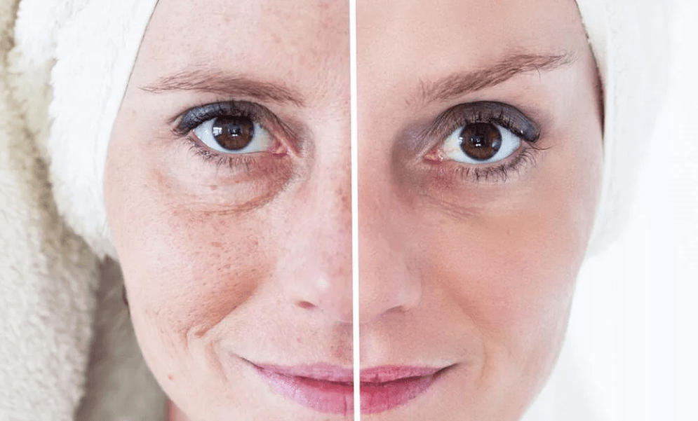 ανανέωση προσώπου με λέιζερ